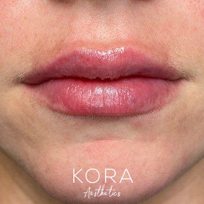 Natural lip filler