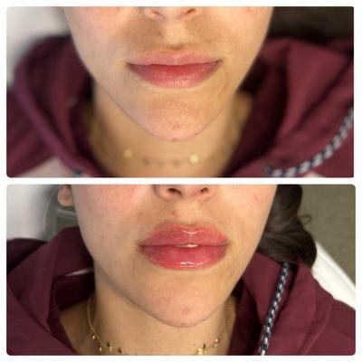 Lip Filler!