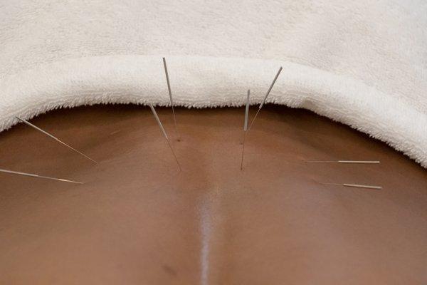 Dry Needling/Trigger Point Needling