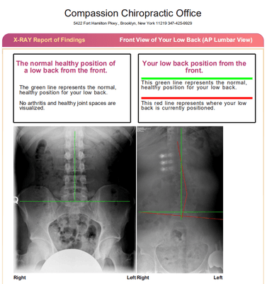 Lumbar x-ray