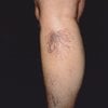 spider veins before treatment