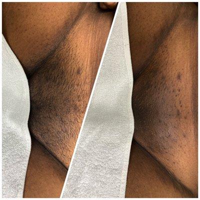 Before and after sugaring client. Sugaring is a good alternative for more sensitive skin or someone struggling with ingrowns from hard wax.