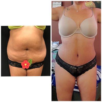 Tummy Tuck 4 weeks post op