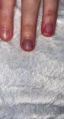 bruised nail bed