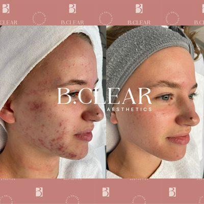 Clear Skin is Possible! Before and After results from our Acne Treatment program