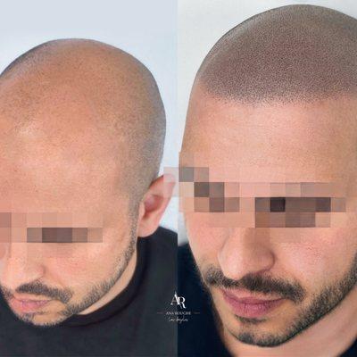 A hairline tattoo, known professionally as scalp micropigmentation, offers a life-changing solution for those seeking a natur...