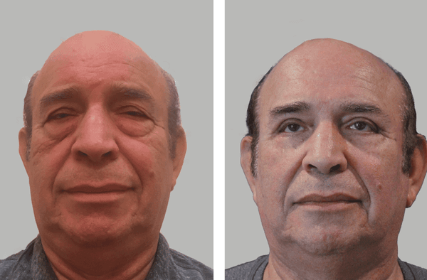 Before and After Blepharoplasty (Eyelid Surgery) by Dr. David Feldmar | Feldmar Aesthetics in Beverly Hills, CA