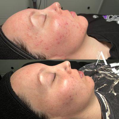 Acne Bootcamp Results