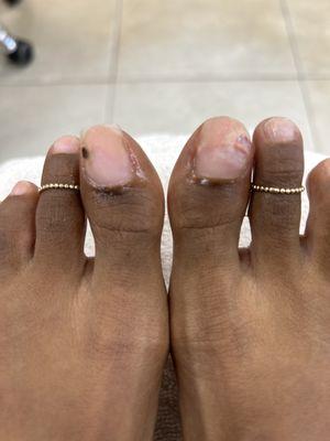 Internal bleeding on both big toes from Kim digging and overly filling