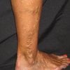 varicose veins before treatment