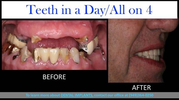 Teeth in a Day / All on 4 Dental Implant Procedure. Actual patient BOTH upper & lower jaw treated. Same day results