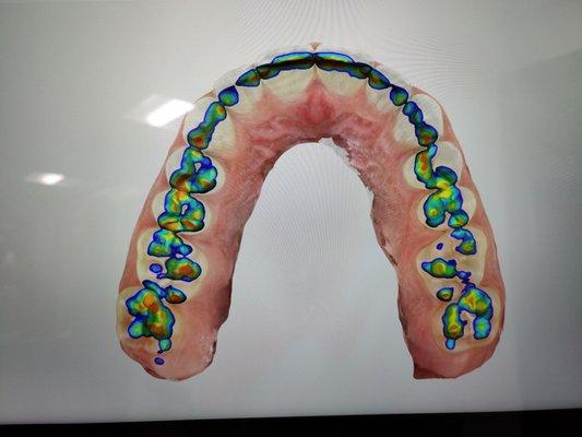 This tech is next level. This is a heat map of my teeth!