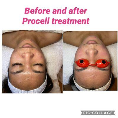 Before after if our Procell facial treatment