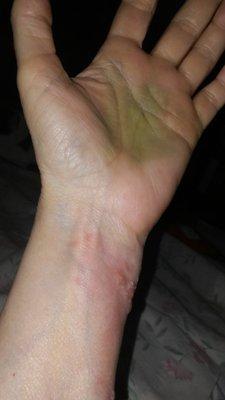 Recent broken left hand