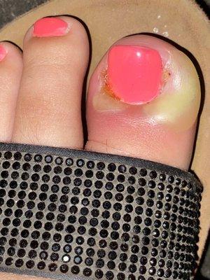 Infected toe!!