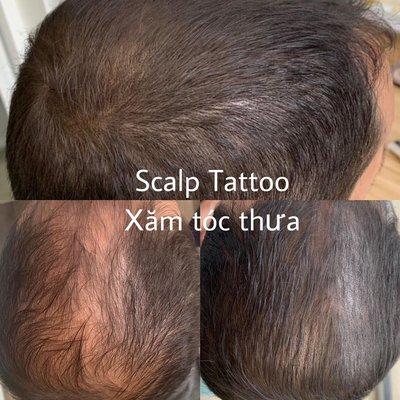 Scalp