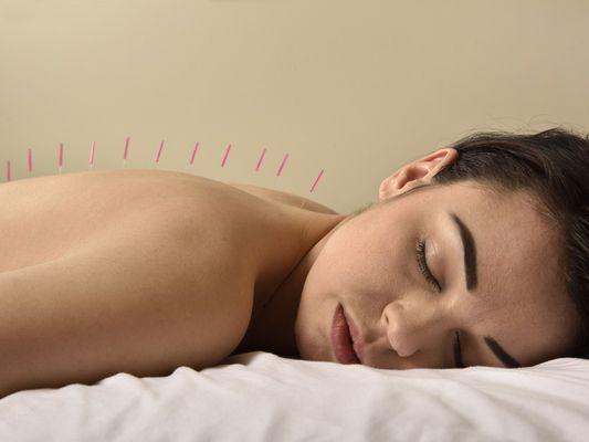 acupuncture treatment McKinney tx