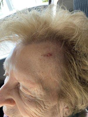 Sassy Hair burn to 88yr old forehead from curling iron!