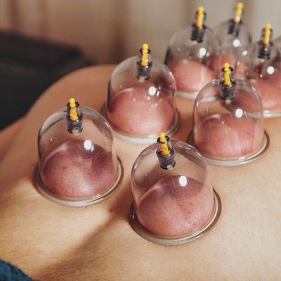 Cupping therapy