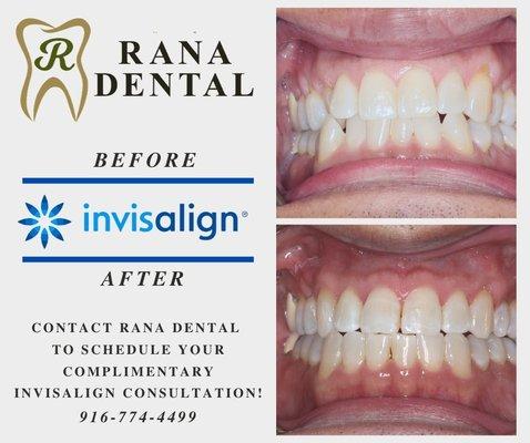 Before and After Invisalign