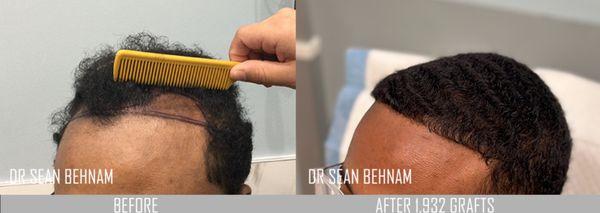 FUE hair transplant: 1,932 grafts placed at hairline. Notice the naturalness and density. Work performed by Dr Sean Behnam.