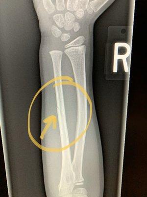 Small fracture that the radiology department found. They get you in and out quickly here