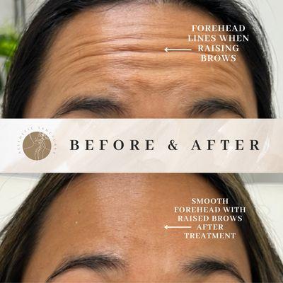 Forehead Botox to address fine lines and wrinkles for a smooth, youthful appearance.