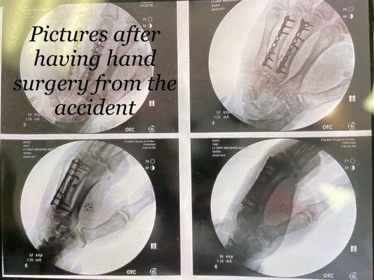 My X-ray of my hand after having hand surgery from the accident.