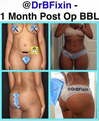 1 month Post op BBL by DrBlyer