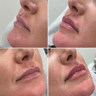 Lip enhancement