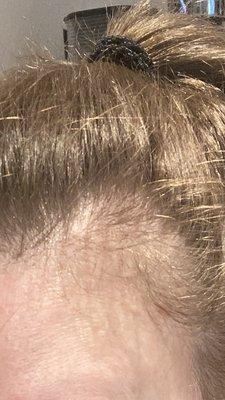 My damaged hair w scalp showing.