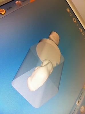 Cerec CAD technology:  this is my new crown being designed.