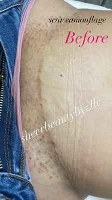 Tummy tuck scar before scar camouflage