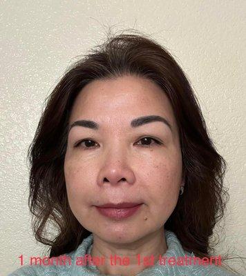 1 month after 1st Tempsure treatment