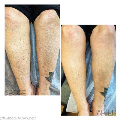 Before and After Half Leg Wax