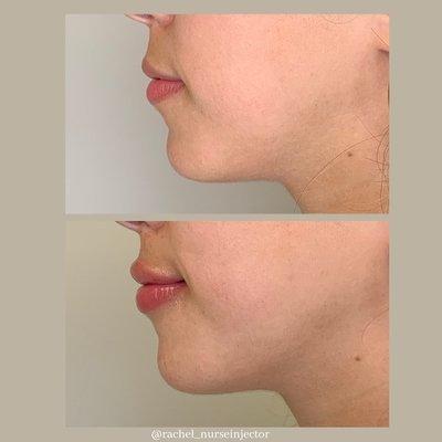 Lip filler results by Rachel Pavone, RN