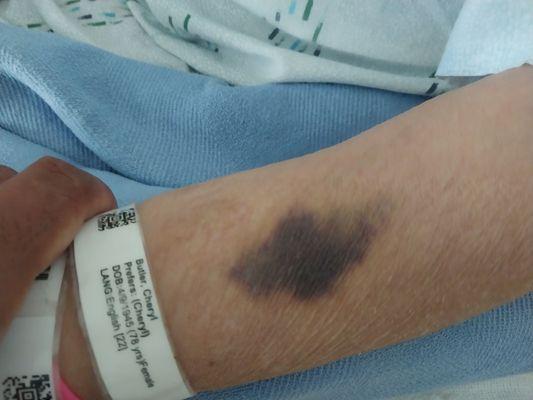 Bruise from abuse at Windsor by another resident after being sexually assaulted.