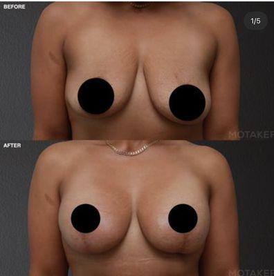 Breast Augmentation and Breast Lift