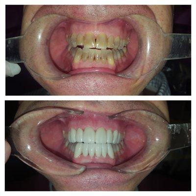 Our Patient was very excited about his new smile. Smile Design by Dr. Troy Rodriguez.  - Tetracycline Stain Restoration. #DDS