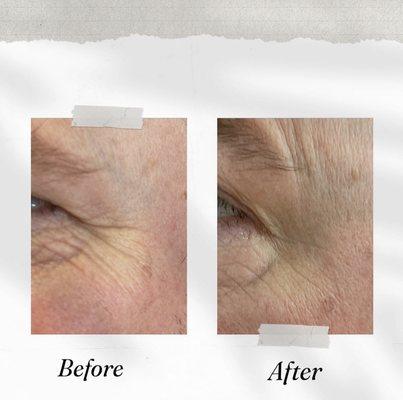 Crow's feet also called smile lines around eyes!! Botox helps improving these deep lines around your face and give more natural look!!!