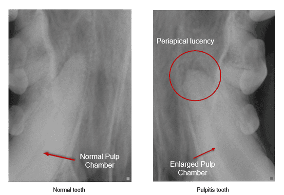 Pulpitis of a tooth