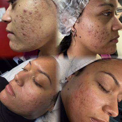 Acne Treatments with Microdermabrasion