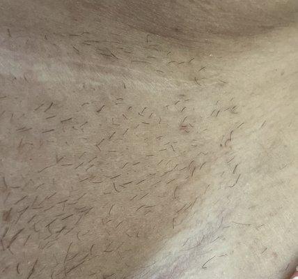 Not shaving in five days after three months of last treatment of 13th session