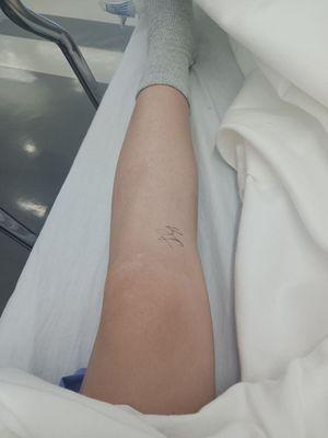 My leg prior to going into surgery. I had a patella out of place and loose ligaments.