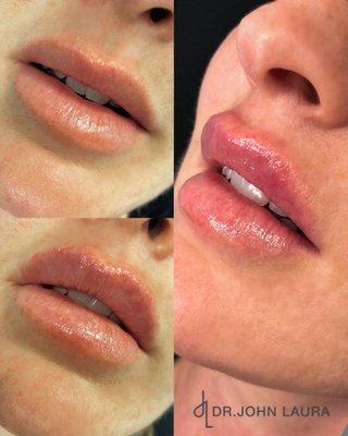 Lip Augmentation with Filler