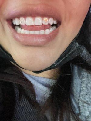 The whitening looks real good and so do the gems but didn't last :(