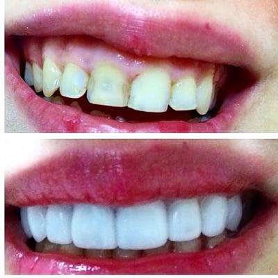 Ceramic Crowns, Before and After :-)