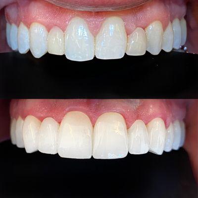 Two 3-unit bridges replaced to correct alignment, aesthetics, and function. The result is a beautiful natural smile. #smilemakeover