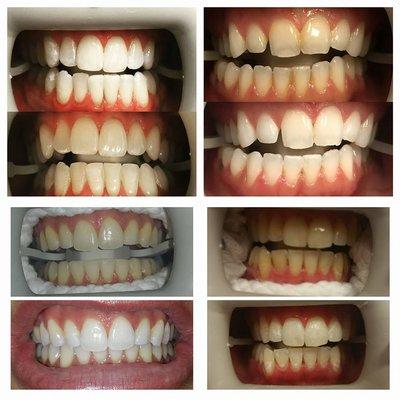 Some of the amazing results we have seen from Zoom! Whitening in-office treatments.