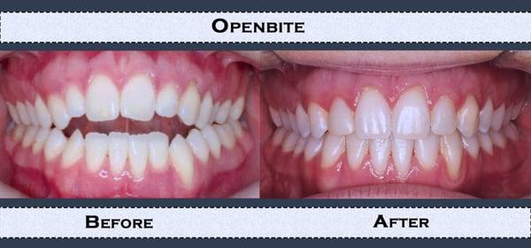 Our Work: Example of Openbite before and after treatment.